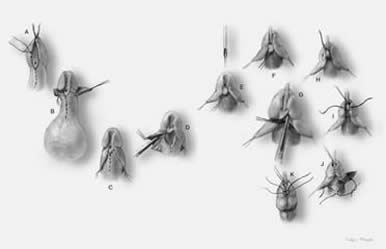 JL Hypospadias Repair