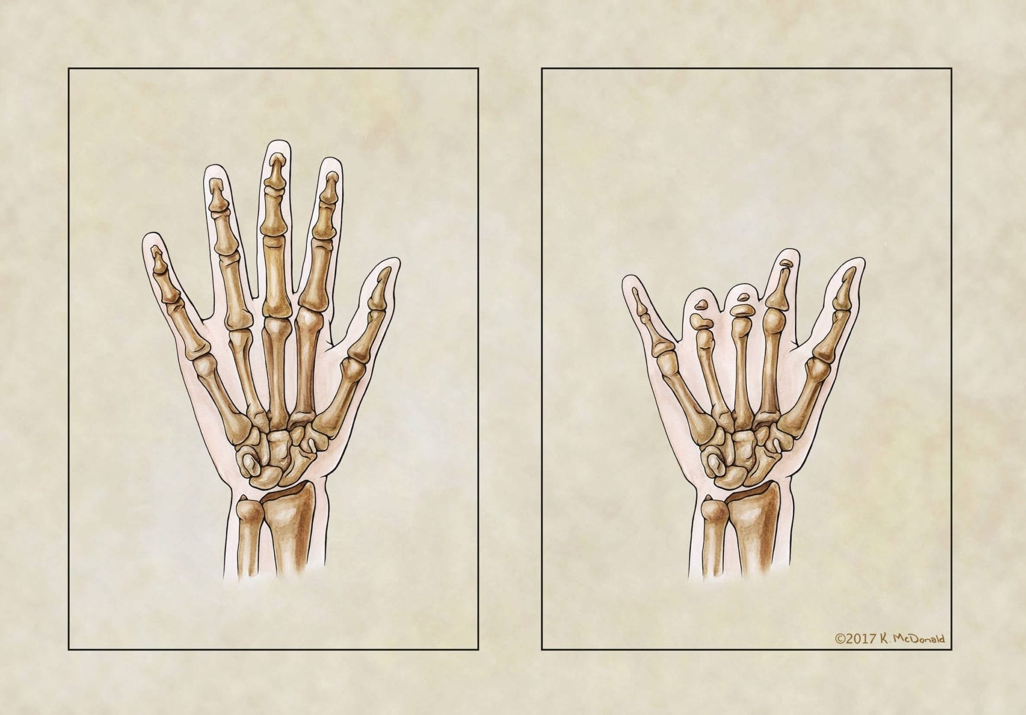 Medical illustration comparing typical hand to a hand with ectrodactyly