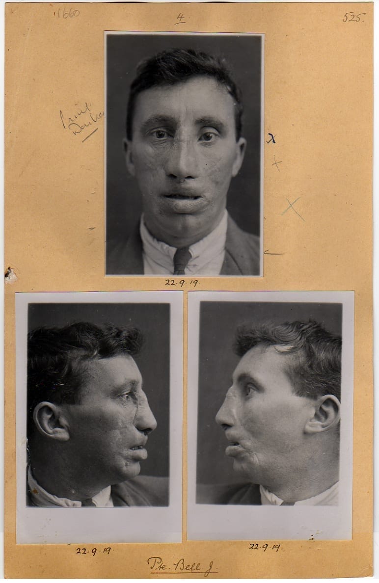 A series of black and white photographs showing the progression of reconstruction following facial injury.