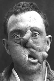 A black and white photograph showing initial efforts at reconstruction following facial injury.