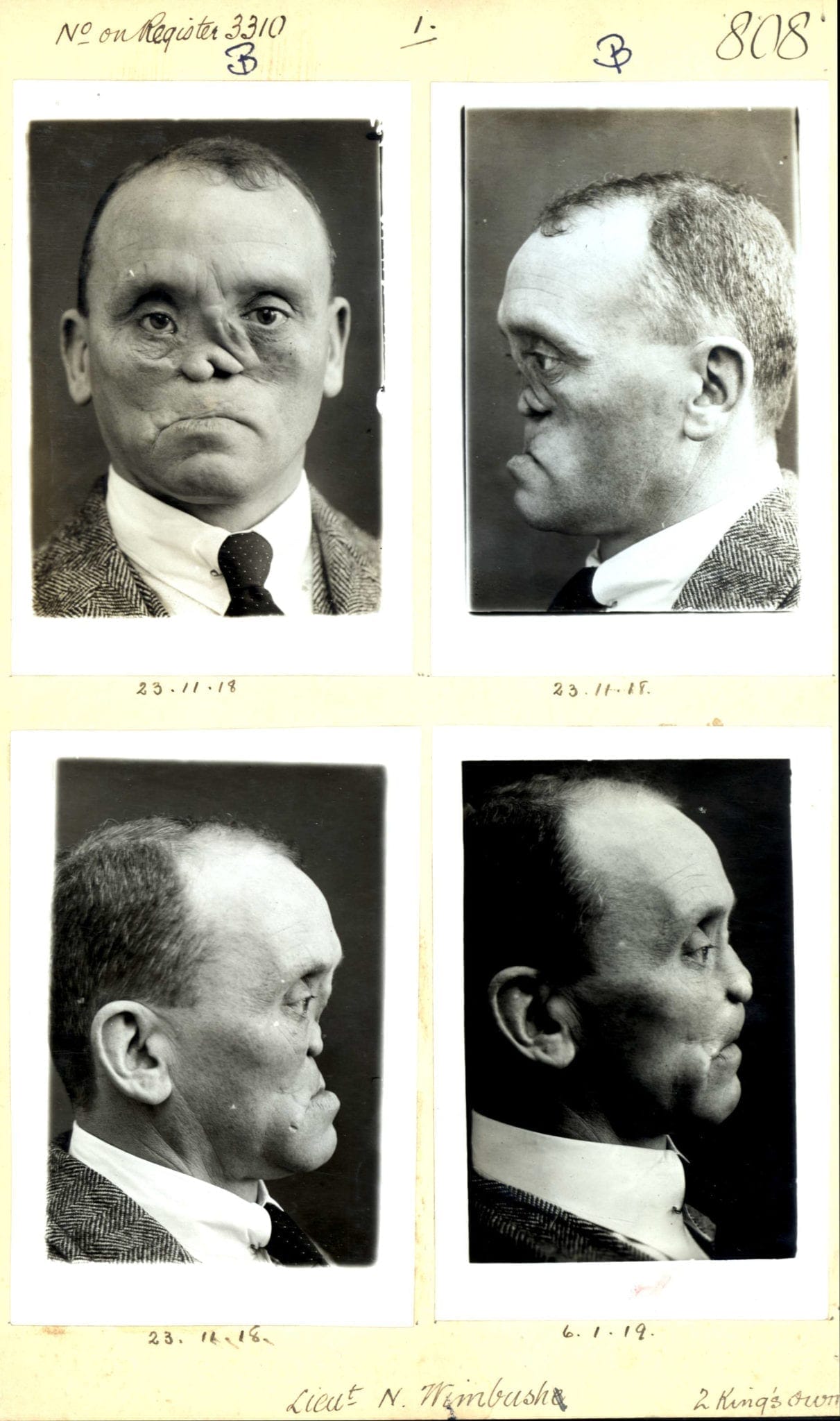 A series of black and white photographs showing the progression of reconstruction following facial injury.