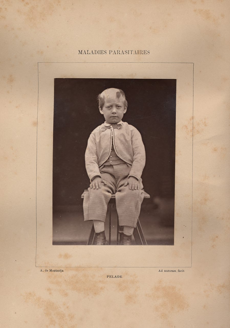 A young boy with alopecia poses for a photograph