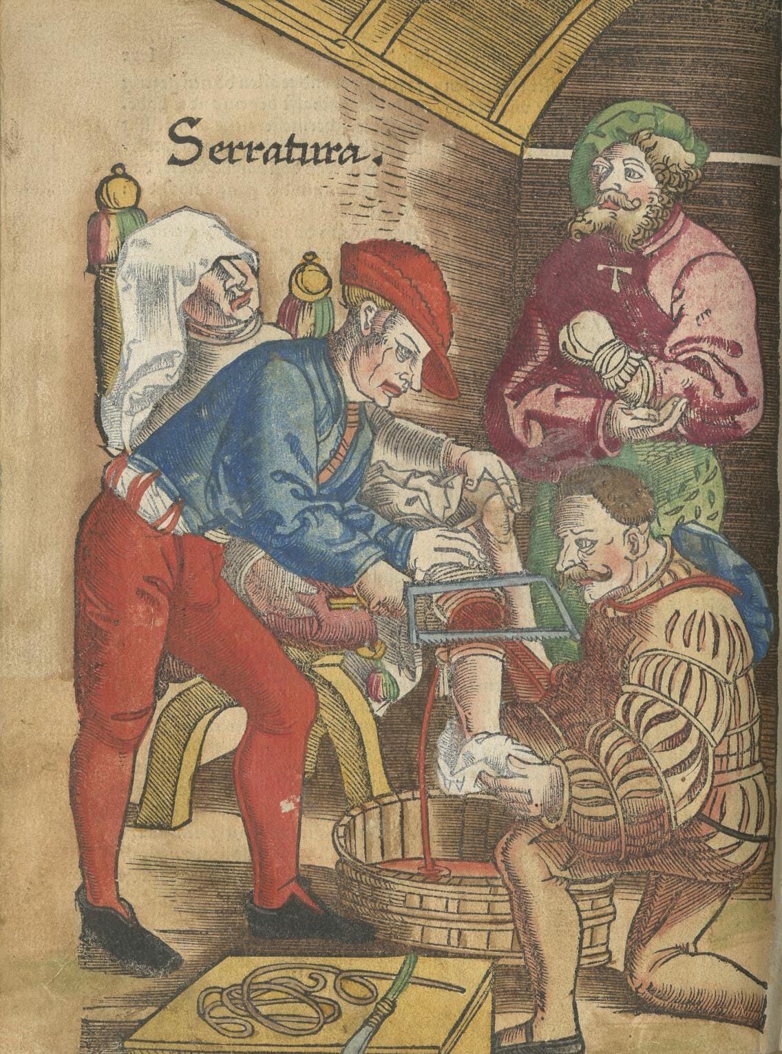 Drawing of amputation of leg