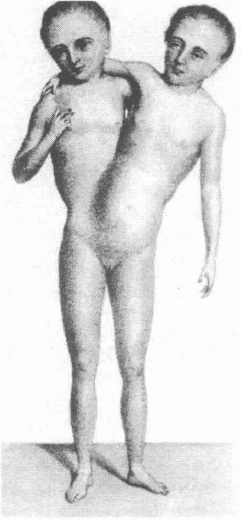 Illustration of conjoined twins