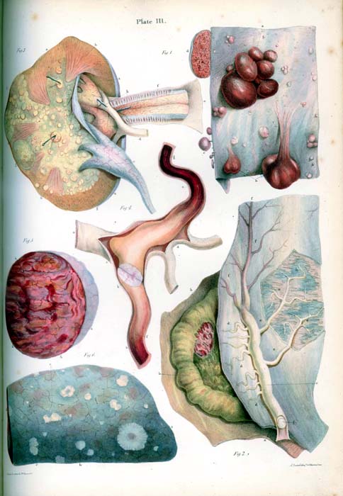 Illustration from Pathological Anatomy Illustrations of the Elementary Forms of Disease by Robert Carswell