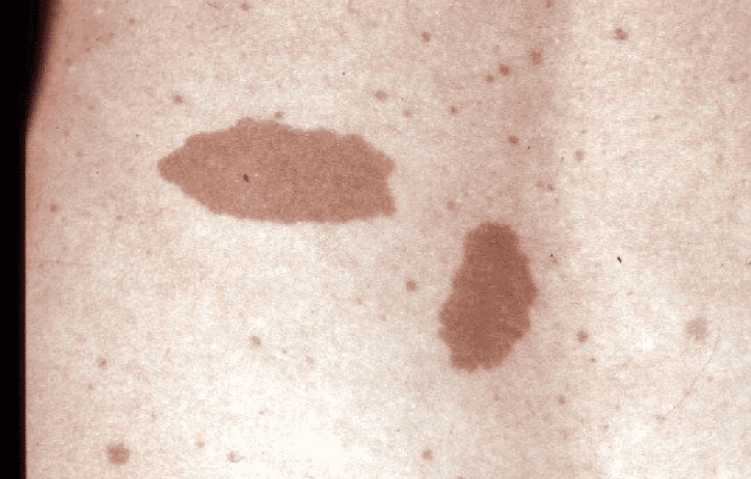 Cafe au lait patches in NF1, subject of a medical metaphor