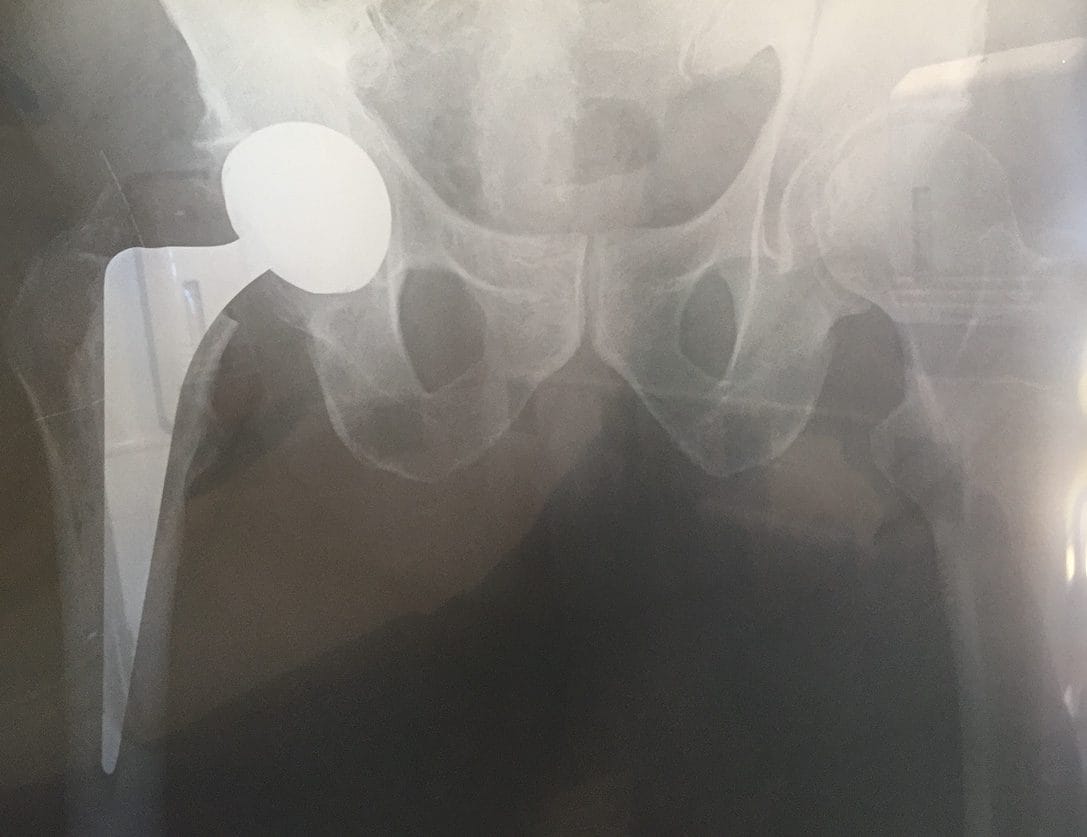 X-ray of hip replacement