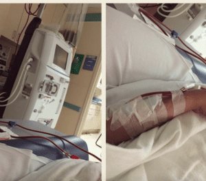 Fistula in arm used for dialysis prior to kidney transplant