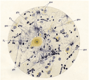 Tangles and plaques as in Alzheimer's disease
