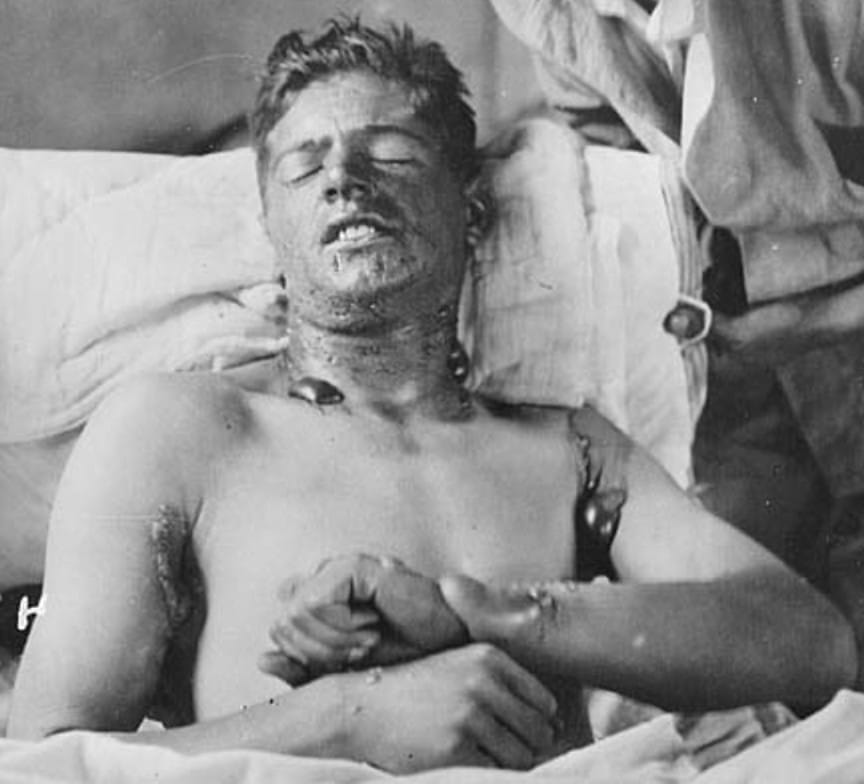 An unidentified white man in pain from mustard gas. The use of mustard gas indirectly led the way to chemotherapy research.